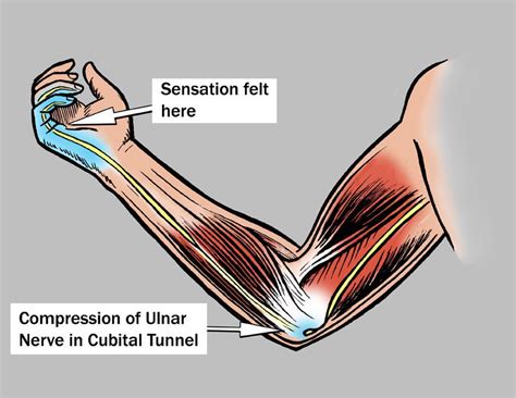 compression test cubital tunnel|is cubital tunnel syndrome serious.